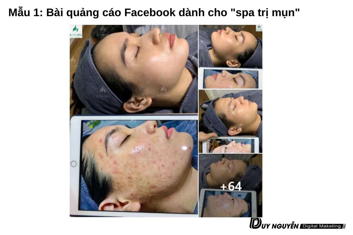 mẫu 1 content spa trị mụn